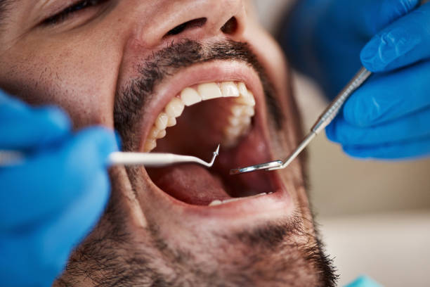 Best Emergency Tooth Extraction in Pineville, LA